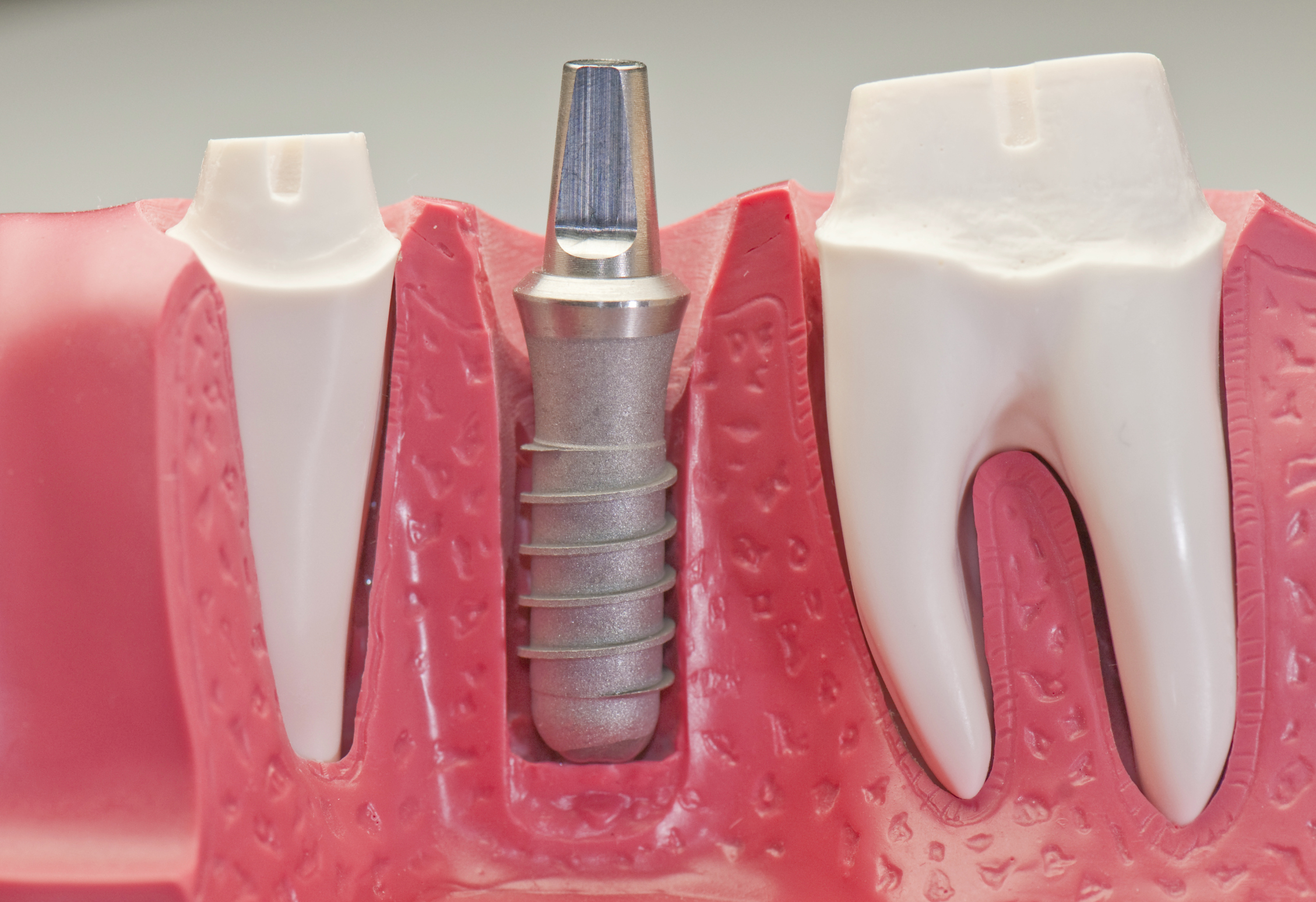 https://www.clinicamegadent.ro/wp-content/uploads/dental-implant.jpg