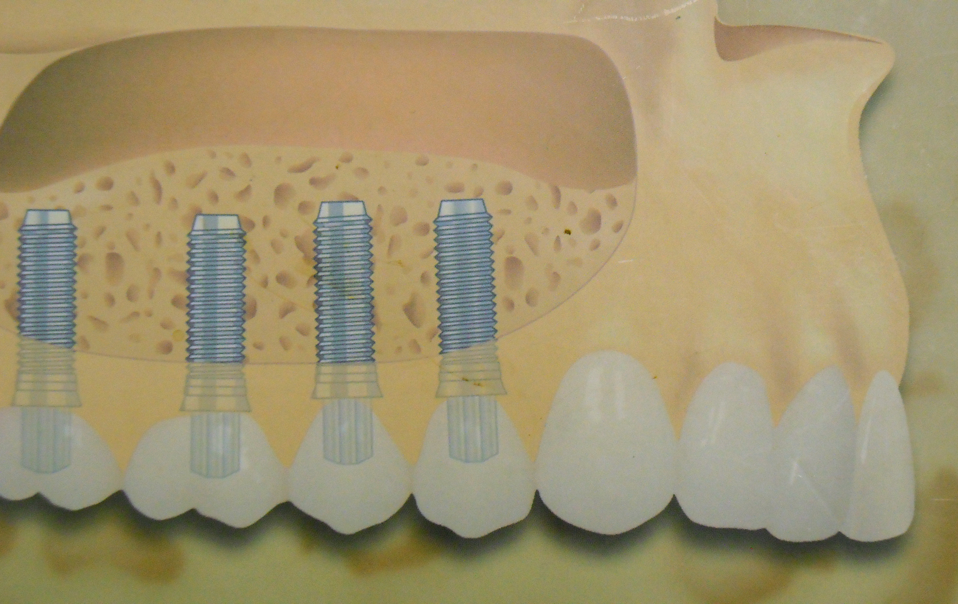 https://www.clinicamegadent.ro/wp-content/uploads/sinus-lift.jpg